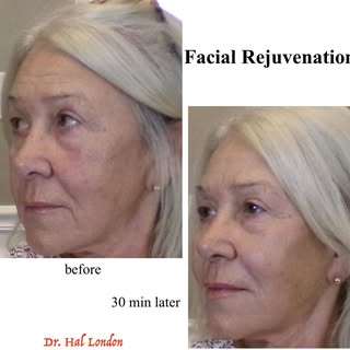 MID AND LOWER FACE ENHANCEMENT 6-15-26 Dr. Hal London

Before and after enhancement of the mid and l