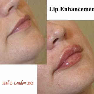 LIP ENHANCEMENT 6-16-26 Dr. Hal London 

A nice example of lip enhancement immediately after her tre