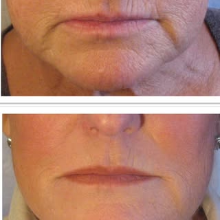 BEFORE AND AFTER MID AND LOWER FACE TREATMENT- Dr. Hal London 

These unfiltered photos are of my pa