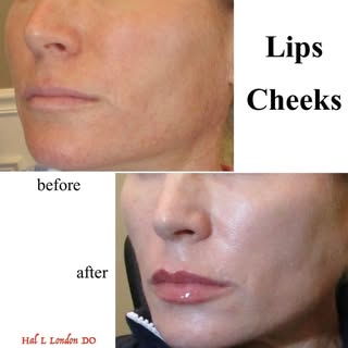 LIPS AND CHEEKS- Dr. Hal London 

One of my favorite combination treatments provide instant results 