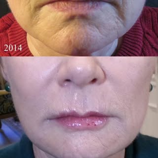 BEFORE AND AFTER- 11 years apart- Dr. Hal London 

These photos were taken at her first visit and th