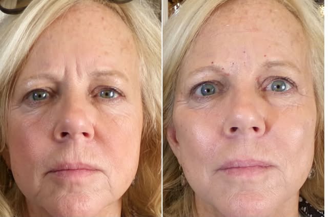 BEFORE AND AFTER FACIAL REJUVENATION 
Dr. Hal London London Medical Spa

This is a great example of 