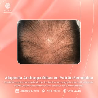 Trastorno capilar progresivo de origen hormonal y genético que provoca la disminución de la densidad
