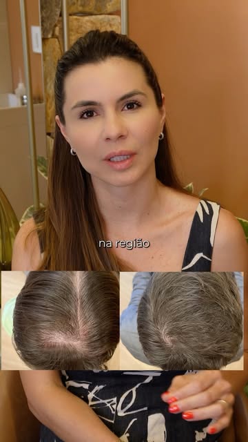 Quanto antes você começa, mais cabelo você preserva. Simples assim.
Esse paciente procurou ajuda enq