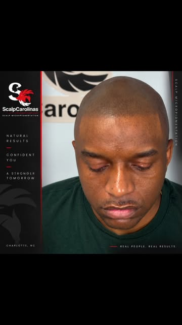 Real people. Real results. 🔥

Scalp Micropigmentation isn’t about creating something that looks art