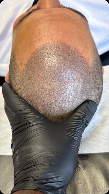 Clean. Natural. Undetectable. 🔥

This is what Scalp Micropigmentation done right looks like—careful