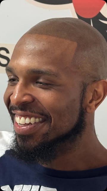 🔥 A fresh hairline. A natural finish. A whole new confidence.

This is what SMP is all about—creati