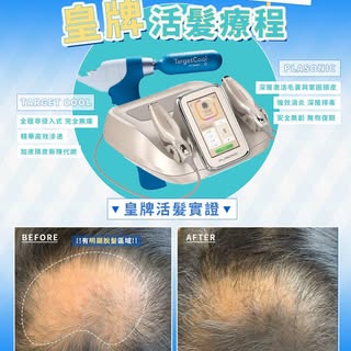 【地中海救星🚨】頭頂越見越疏，下下要靠戴帽遮？一招逆轉脫髮命運！🚀

照鏡見到頭頂出現明顯嘅脫髮區域，甚至連周圍嘅頭髮都開始變得稀疏、幼細無力？😨 好多男士一遇到「地中海」危機，就以為毛囊已經無