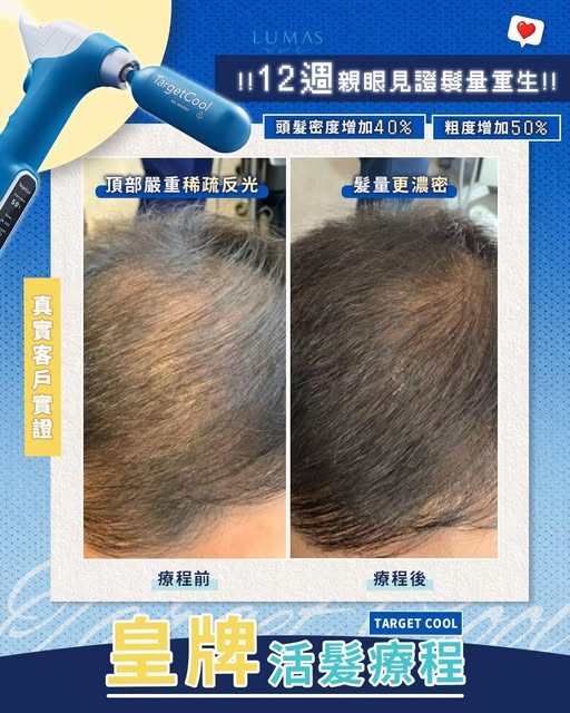 【拒絕盲目植髮 🙅‍♂️】12週親眼見證髮量重生，告別頭頂反光！✨

面對「地中海」或頭頂嚴重稀疏，脫髮未必需要行到植髮最後一步！只要毛囊仲未完全萎縮，用啱頂尖活髮科技，絕對可以逆轉稀疏命運。

L