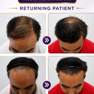 HAIRLINE RESTORATION JOURNEY: Our returning patient is back 2 years after his hairline restoration—a