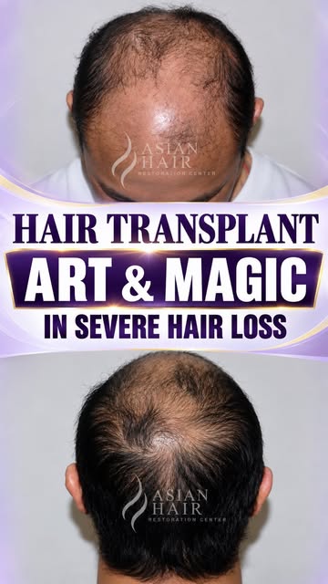 “I’m an artist. I’m a magician,“ says our hair transplant surgeon, Dr. Arambulo. Watch how we transf