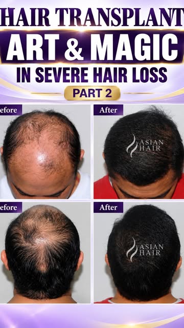 From severe hair loss to a remarkable transformation. ✨
Hair Transplant: Art & Magic — Part 2

Resto