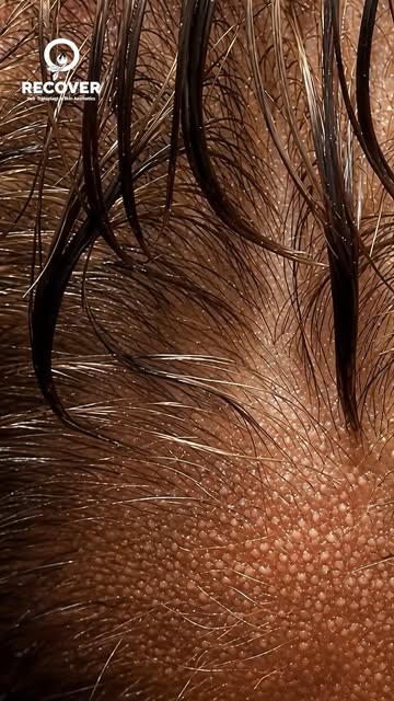 Precision. Expertise. Natural-looking results. 

Every hair transplant is a journey that demands ski
