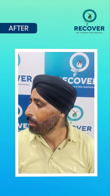 A transformation that speaks for itself. 

From before to after, this beard transplant journey showc