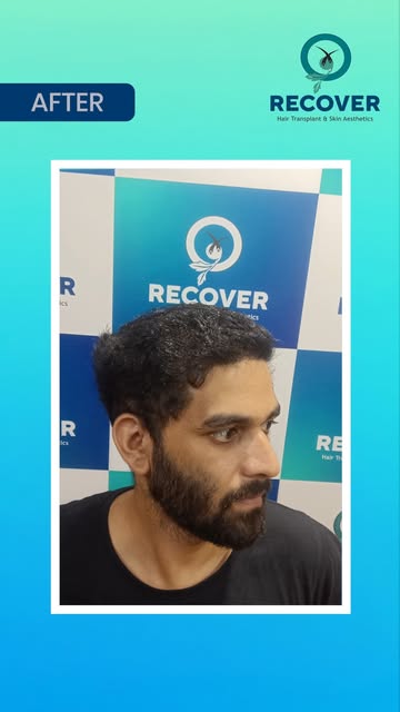 Say goodbye to hair loss and hello to natural density! 

Witness this incredible transformation at R