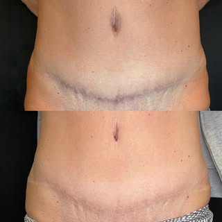 Only two sessions in and already loving these healed results 🤍 Tummy tuck scar camo is all about re