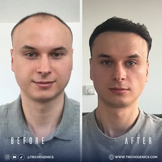📅 Incredible 6-month transformation! This 30-year-old patient started with 6 months of pre-op Finas