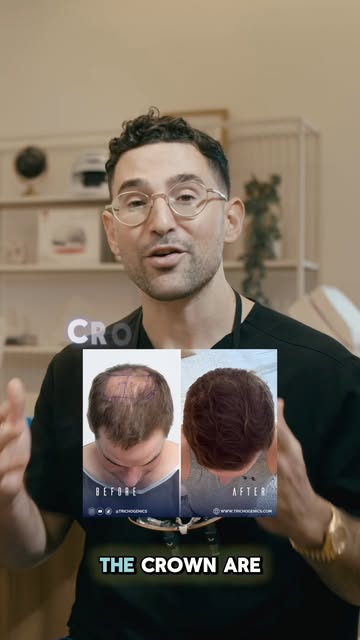 The crown is one of the HARDEST areas to restore in a hair transplant. 👀

Why? Crown hair grows in 