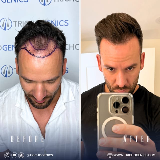 A transformation to a fuller, more natural looking hairline. 🤍

Every hair transplant is different.