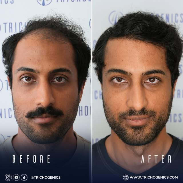 Hair Transplant Before & After! 10 Month Results 🤩

▫️ 32 years old
▫️ Male
▫️ Post op 10 months
▫️