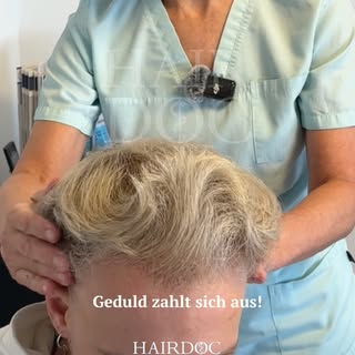 Viele Patienten sind überrascht: Das endgültige Ergebnis einer Haartransplantation braucht Zeit. Nac