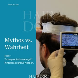 Kurz und knapp: Jede Haartransplantation hinterlässt Narben. Es ist eine Operation, wenn auch ein mi