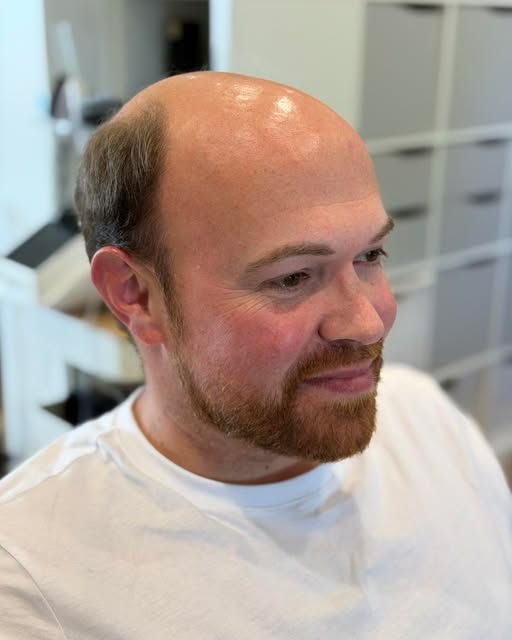 Thinking about a hair system? 
Look at the difference it can make to how you look and with that come