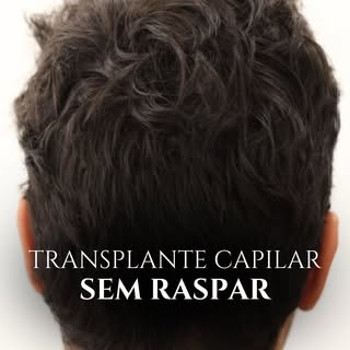 10 dias após Transplante Capilar sem raspar nada do cabelo 😲

Poucas pessoas sabem que isso é possí