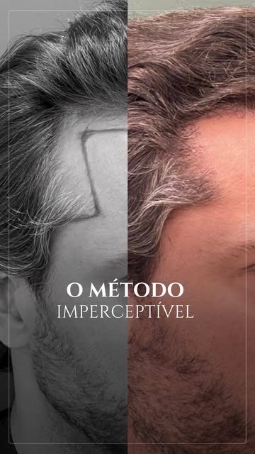 Esse resultado mostra a discrição do Transplante Capilar sem raspar do 10º dia até 8 meses

Aos 10 d