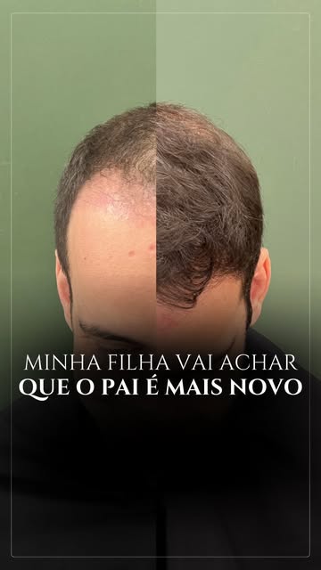 Esse paciente contou uma coisa na consulta que resume o efeito emocional do transplante capilar, que