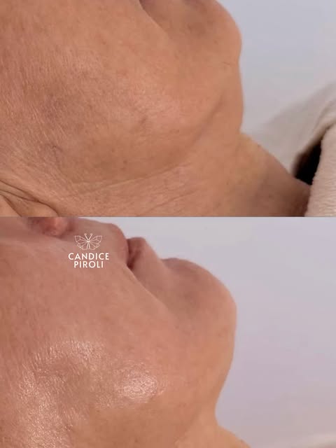 No surgery or injections! This patient lives a toxin free lifestyle so we preformed 4 Microneedling 