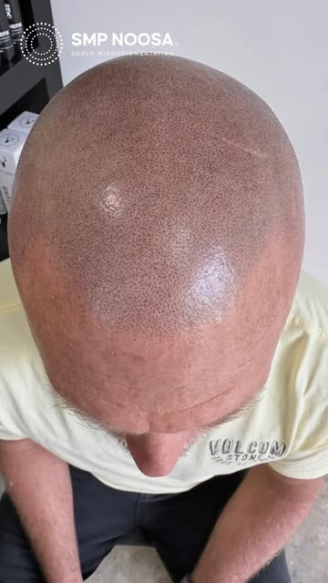 Are you sick of being bald? Tired of looking older than you feel?

It might be time for a little ref