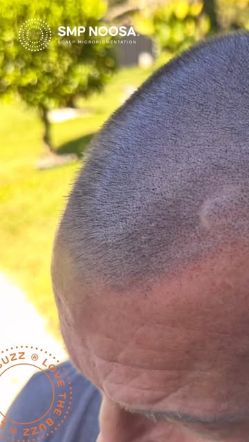 ✨ THINNING HAIR? YOU DON’T HAVE TO SHAVE IT OFF ✨

SMP can be carefully worked through thinning hair