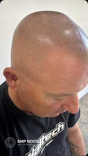 ✨ Only the best in soft, natural, realistic SMP ✨

If you’re looking for scalp micropigmentation tha