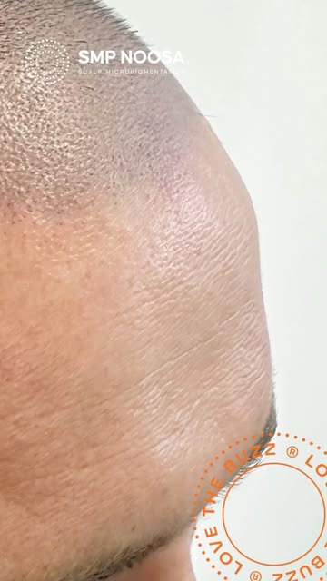 FROM BALD TO BOLD 🔥

What a difference scalp micropigmentation has made for this legend. A natural,