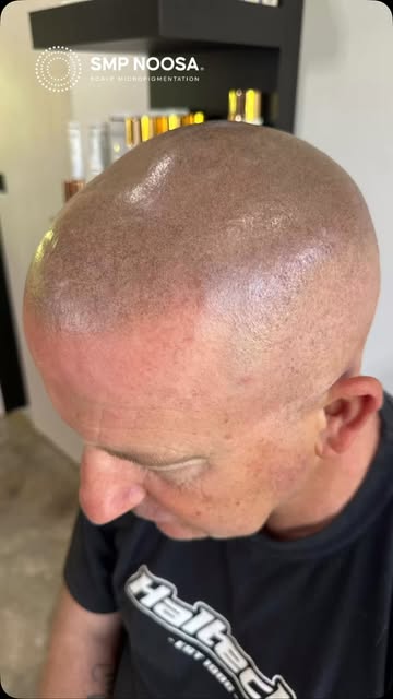 ✨ Amazing what a transformation scalp micropigmentation can make ✨

A natural looking SMP treatment 