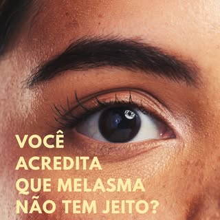 ➡️ Seu melasma sempre recidiva? 

Durante muito tempo o MELASMA foi considerado e tratado como sendo