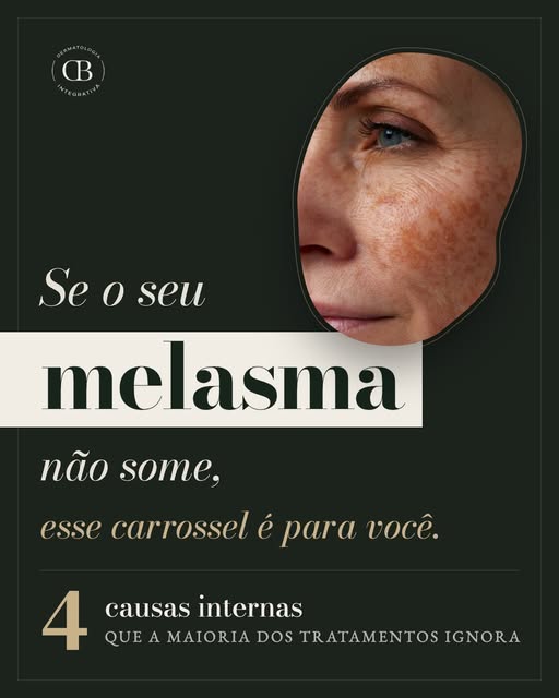 📍 A mancha no seu rosto pode estar respondendo a algo que acontece bem longe da pele. 

Muitas paci