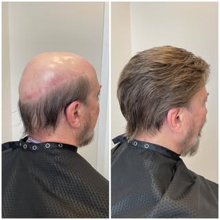 Our guest visits us between 4 and 5 weeks for maintenance. 
•
@advhairloss_ 
#hairreplacementsystem 