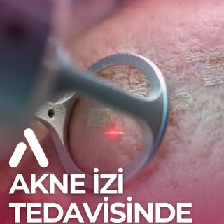 Akne izi tedavisinde neler yapılabilir?

Bu videoda doktorumuz, akne izleri için uygulanabilen tedav