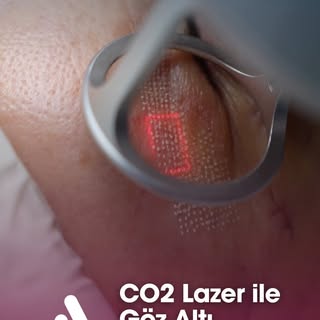 Lazerle göz altı sıklaştırma

✨ CO₂ Lazer ile Göz Altı Sıkılaştırma

Göz altındaki ince çizgiler, ma