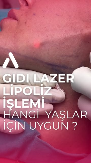 Gıdı lazer lipoliz hangi yaşlar için uygun?
Bu işlemde iki temel etki vardır:
• Gıdı bölgesindeki ya