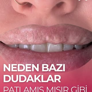 Neden bazı dudaklar patlamış mısır gibi görünüyor?
Bu görünüm çoğu zaman geçmişte uygulanan sıvı sil