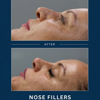 Not every nose concern requires surgery.

Dermal fillers can help smooth small irregularities, impro