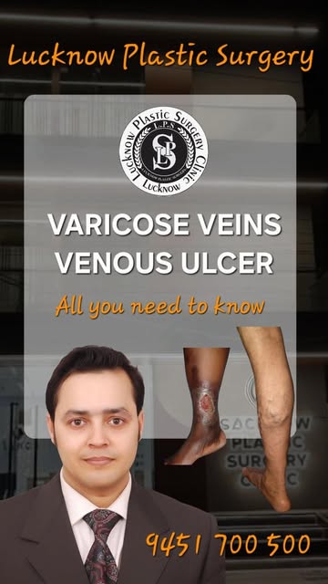 VARICOSE VEINS & VENOUS ULCER — Don’t Ignore the Warning Signs!

पैरों में उभरी हुई नसें, दर्द, भारी