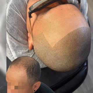 No Hair Spray.
No Fillers.
No Hair Transplants.
No Wigs.
No Surgery.

Just flawless, undetectable Sc