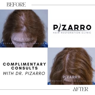 Hair Restoration is Not Just for Men. Dr. Pizarro specializes in Female Pattern Baldness, Alopecia &