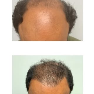 No filters, all results by Dr. Marina Pizarro @pizarrohairrestorationclinic #hairrestoration 🔗 in B