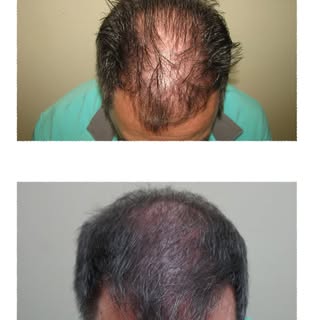 Affordable Hair Restoration by Dr.Pizarro offers reliable results for both men & women. We offer com