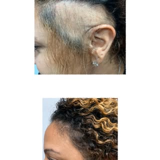 We Treat #alopecia & our Patients Love the New Found Confidence! #alopecianbeauty #alopecia #alopeci